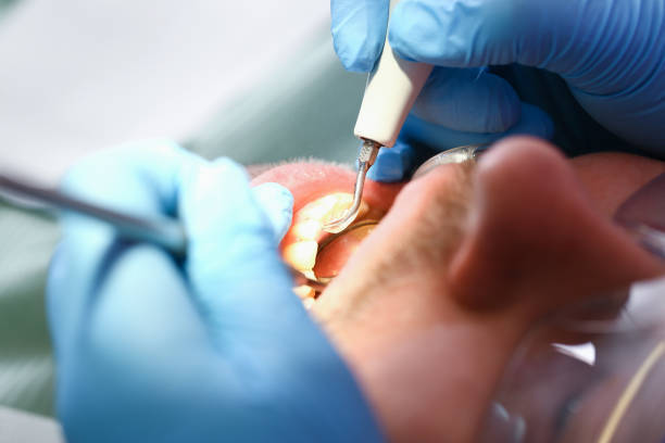 Best Emergency Dental Care for Broken or Chipped Teeth in Monroe, IA