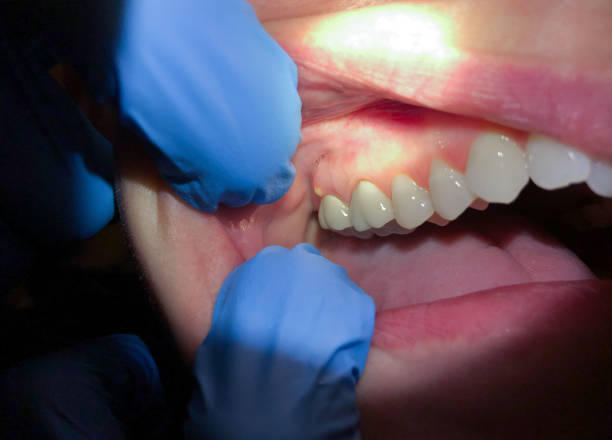 Best Emergency Treatment for Dental Infections or Abscesses in Monroe, IA