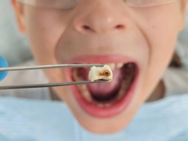 Best Emergency Tooth Extraction in Monroe, IA